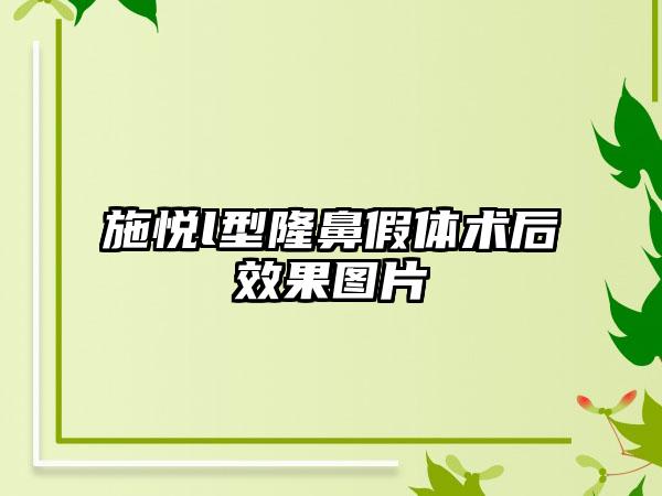 施悦l型隆鼻假体术后效果图片